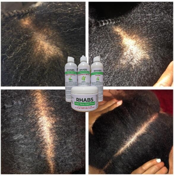 Rhabs Aloe Vera Hair Growth Set